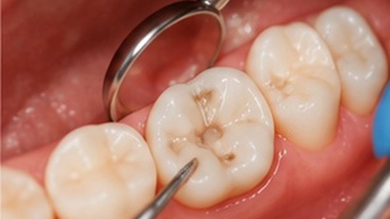 Tannfylling – hull reparert med tannfarget kompositt hos Dentix Tannhelse